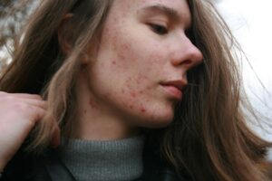 Recepta online na leki na trądzik hormonalny – kiedy można uzyskać leczenie bez wizyty stacjonarnej